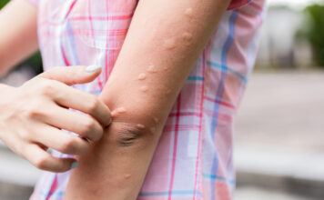 Der nackte Oberarm einer Frau ist übersät mit kleinen Stichen und geröteten Schwellungen. Es handelt sich dabei offenbar um Mückenstiche. Mit der rechten Hand juckt die Frau sich über die Stiche.