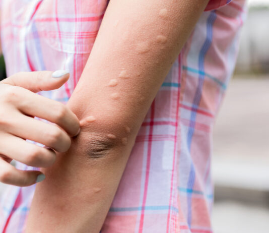 Der nackte Oberarm einer Frau ist übersät mit kleinen Stichen und geröteten Schwellungen. Es handelt sich dabei offenbar um Mückenstiche. Mit der rechten Hand juckt die Frau sich über die Stiche.